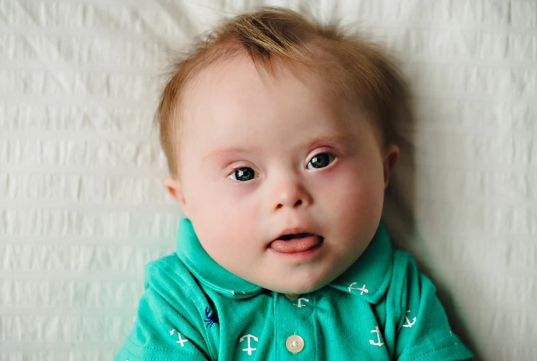 دکتر سندرم داون - اهواز